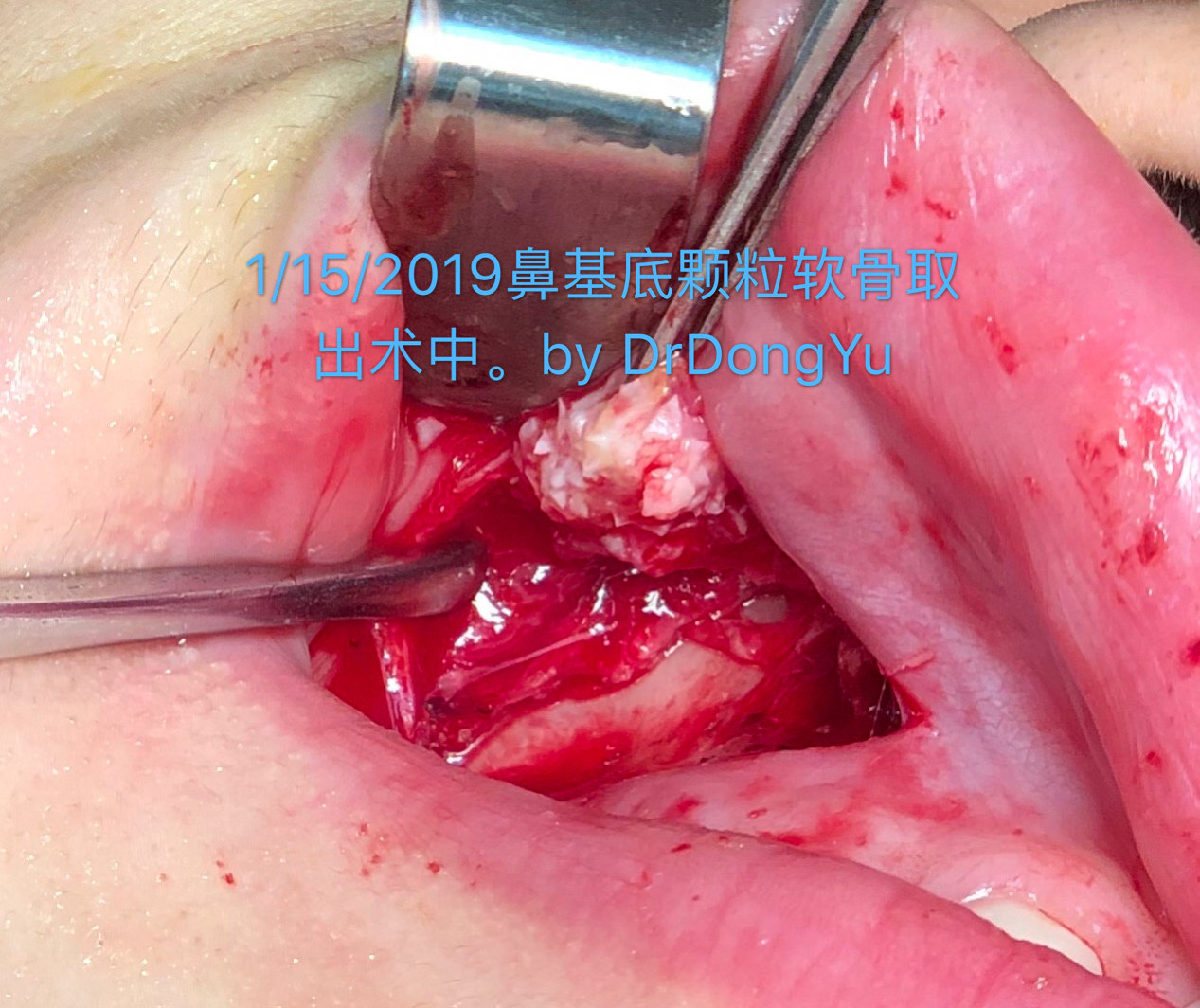 不要用打碎的软骨填鼻基底