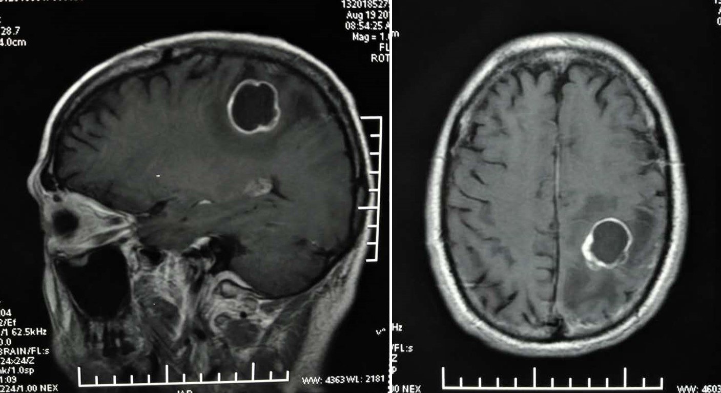 脑转移瘤最需要了解的干货(1):诊断方法_脑转移瘤_脑转移瘤检查 - 好