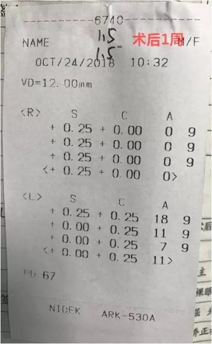 电脑验光怎么看近视度数,电脑验光单怎么看近视度数