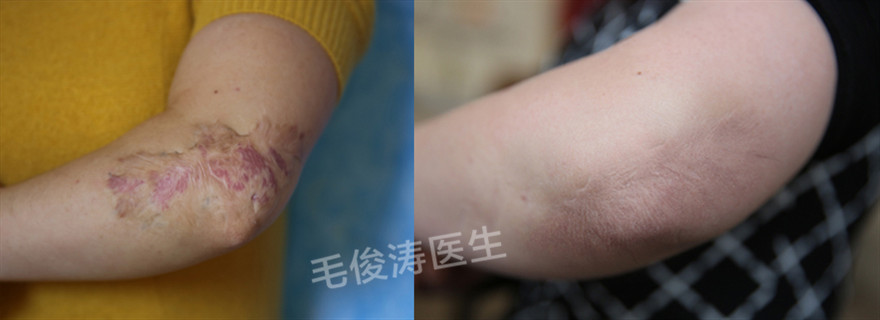 疤痕修复:受伤害后肉芽组织增生及瘢痕形成 - 好大夫在线