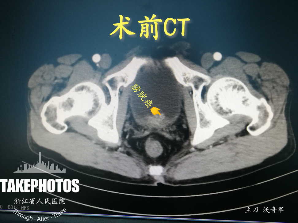 醫生有時會使用超聲來替代ct掃描,不過同樣,注意憋尿啊.