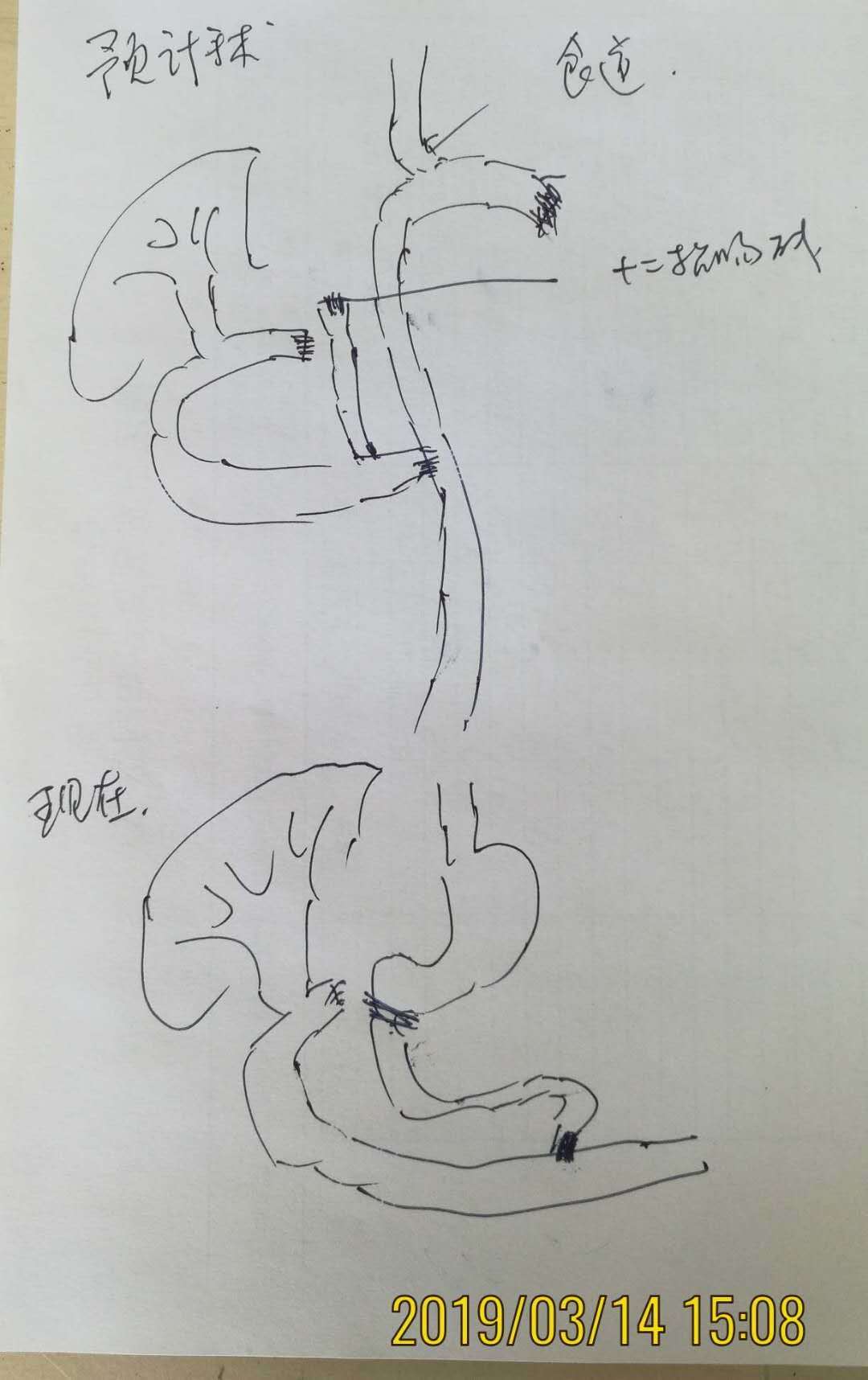右肝膈囊肿内容为果冻,胆肠吻合为结肠前r-y吻合,大网膜饼与胃脾融合