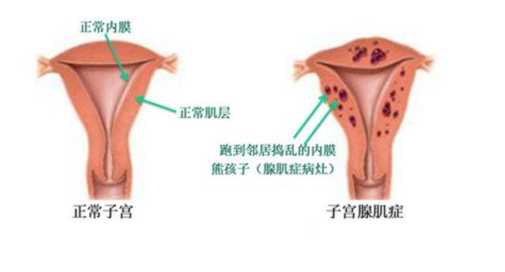子宫腺肌症图解图片
