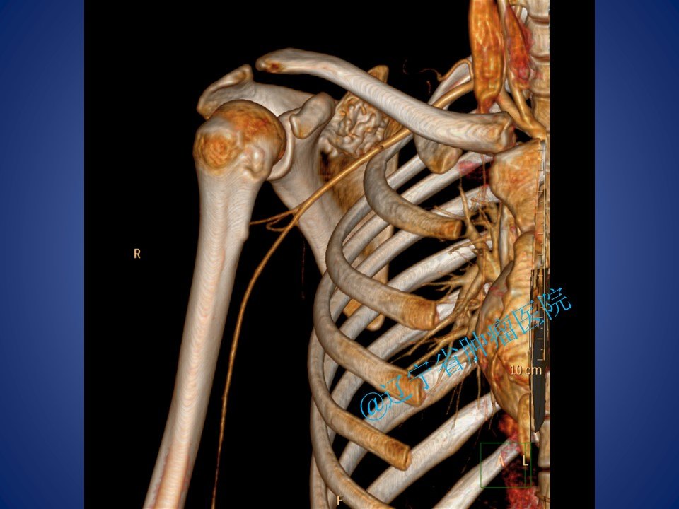 肩胛骨軟骨肉瘤手術病例