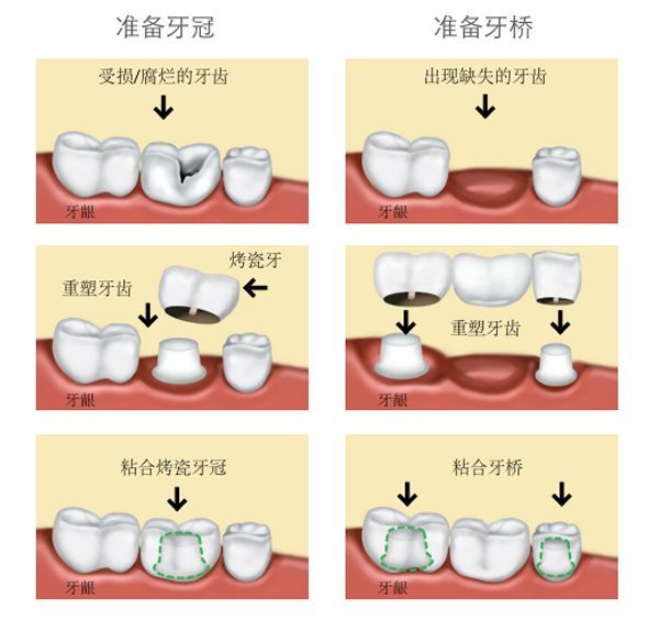 简博士科普如何选择用哪一种烤瓷牙