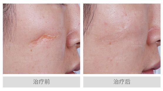 凹陷性疤痕的常见的修复方法