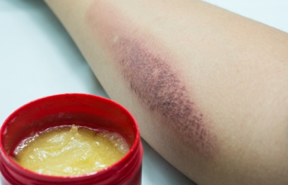 一度烫伤多久黑印会消失 有方法可以帮助尽快恢复吗 烫伤 用药 日常护理 疾病介绍