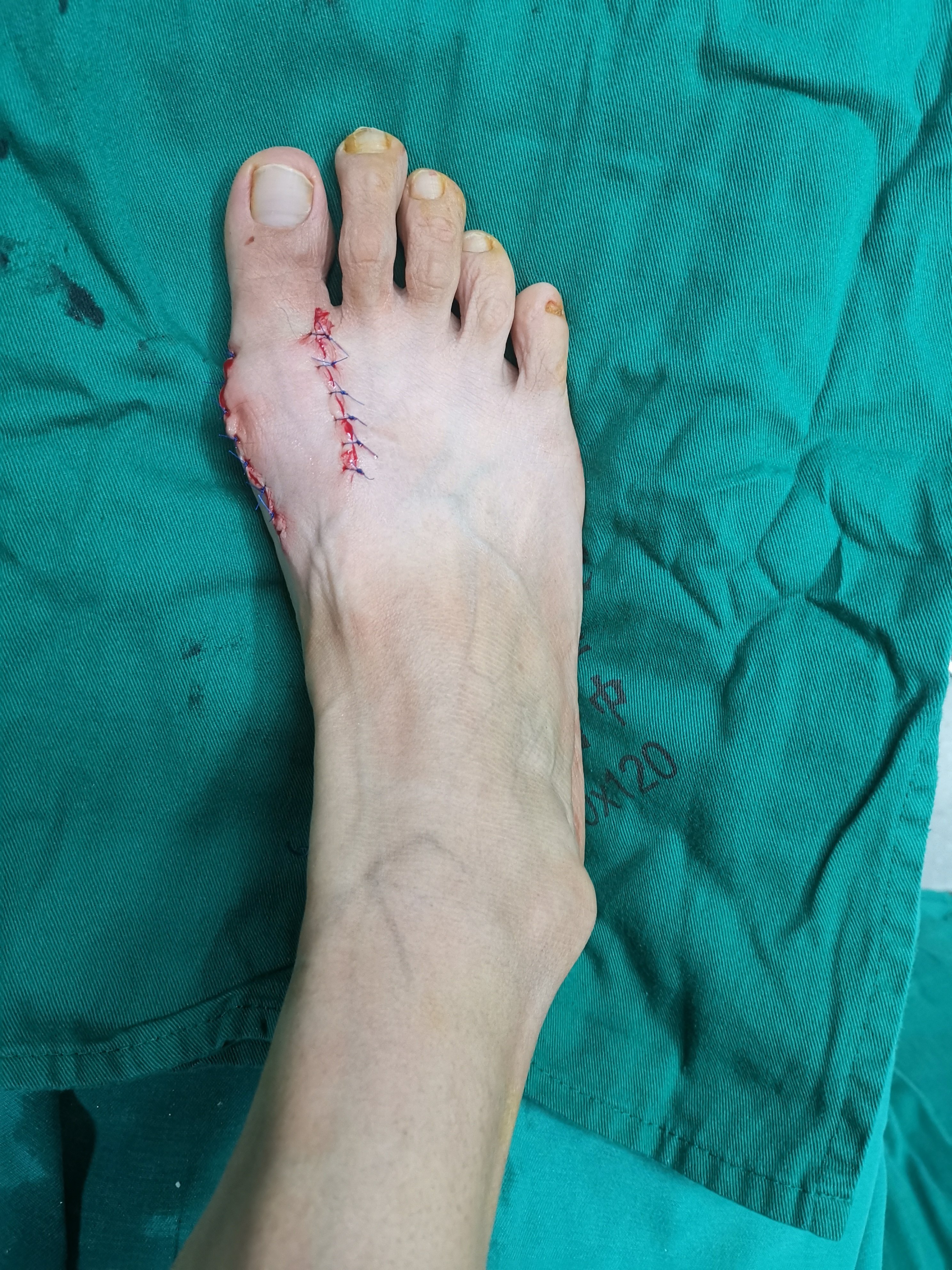 大脚骨手术过程图片