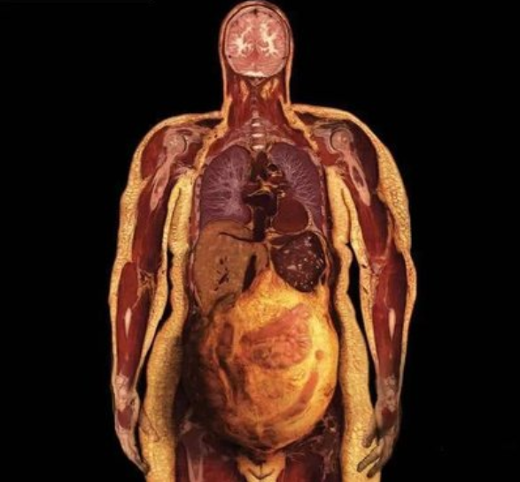 外国胖子大肚子 器官图片