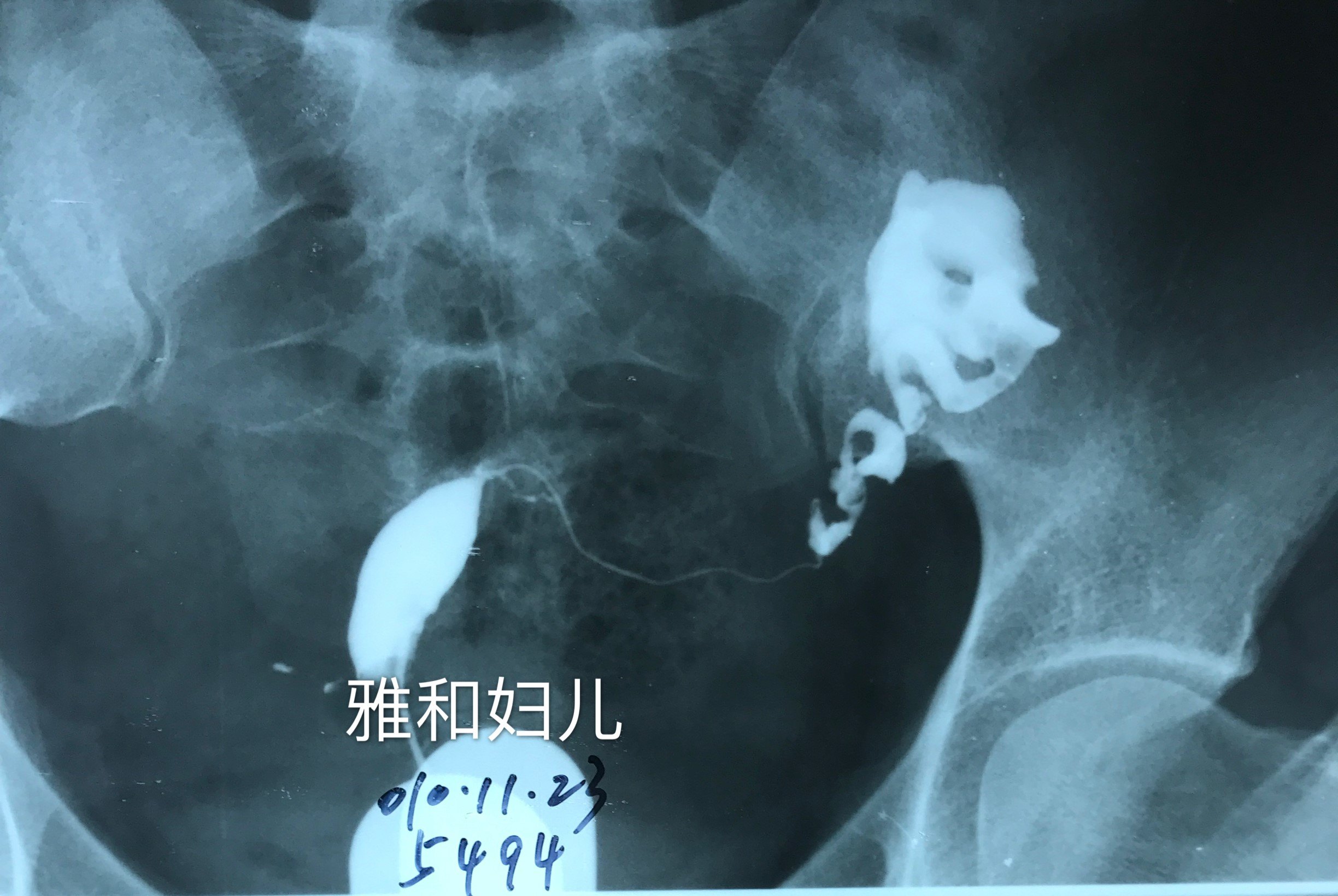 解决大问题的小手术——实时动态子宫输卵管碘油造影术_不孕症_检查
