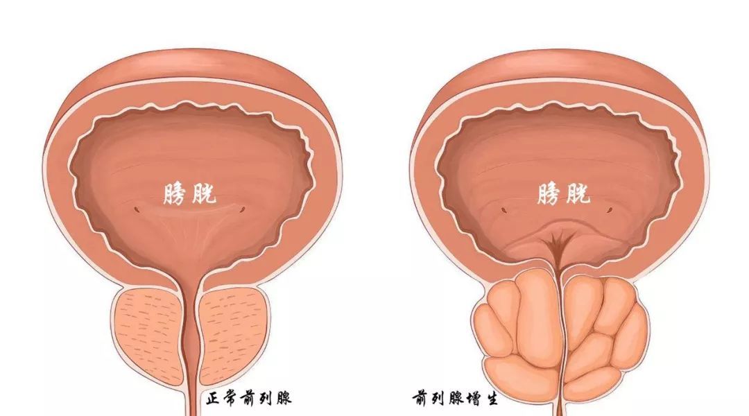 前列腺增生示意图图片