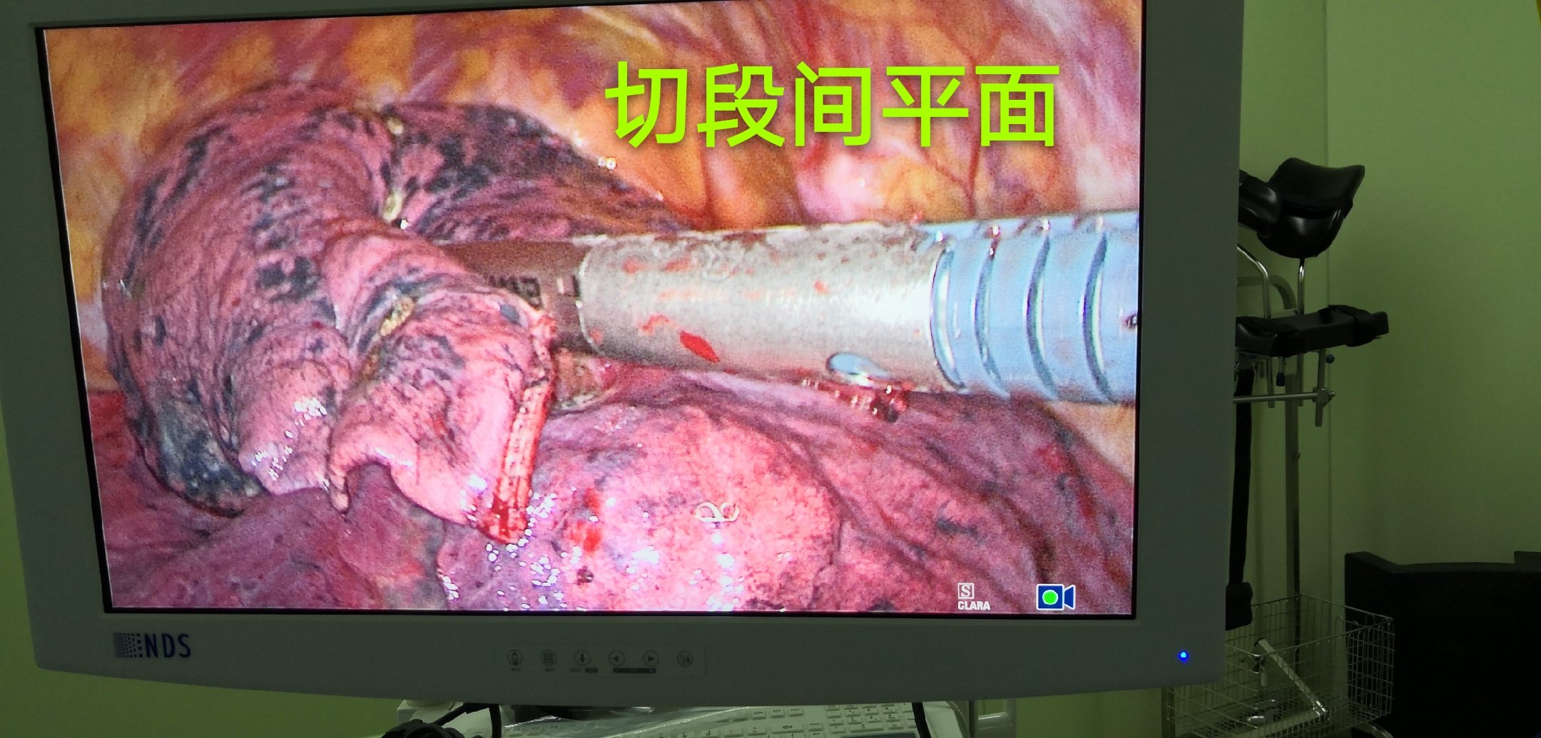 哈医大二院胸外科经典病例之胸腔镜下右肺s2切除术 - 好大夫在线