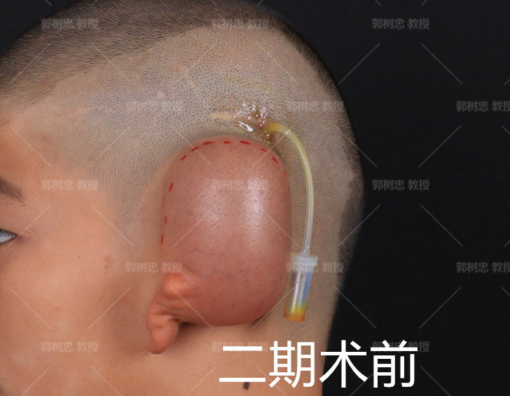 耳再造手术的细节(一)埋置扩张器的切口