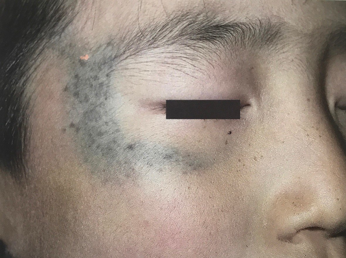 原来这种常见的斑叫褐青色痣_痣_症状表现_治疗方式 - 好大夫在线