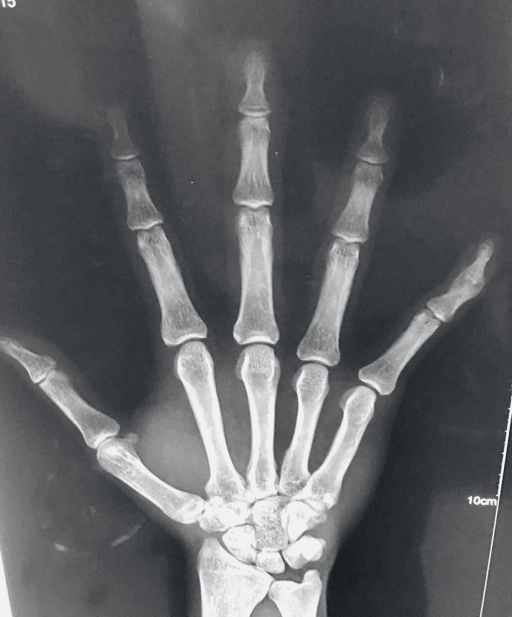 锤状指 伸腱止点撕脱骨折 - 好大夫在线