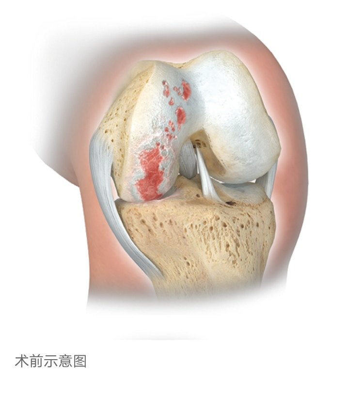 单髁置换是真正意义的微创膝关节置换,手术创伤小,术后恢复快.