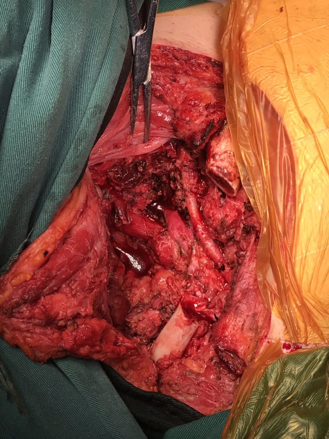 一例巨大颈肩部恶性神经鞘膜瘤在江苏省人民医院骨与软组织肿瘤
