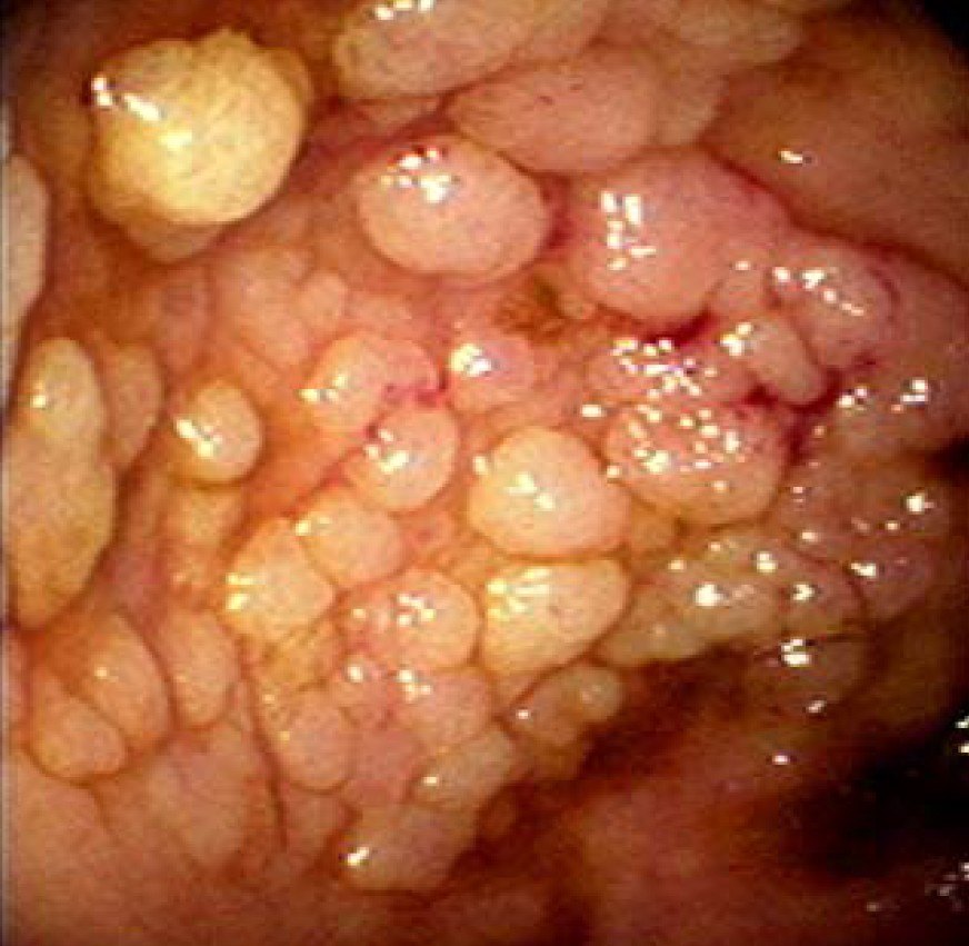 绒毛状腺瘤-Cecal villous adenoma Endosc - UpToDate-1.jpg
