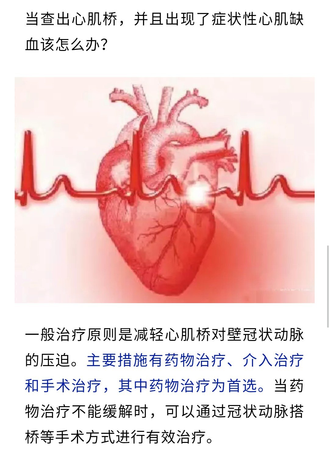 冠状动脉肌桥