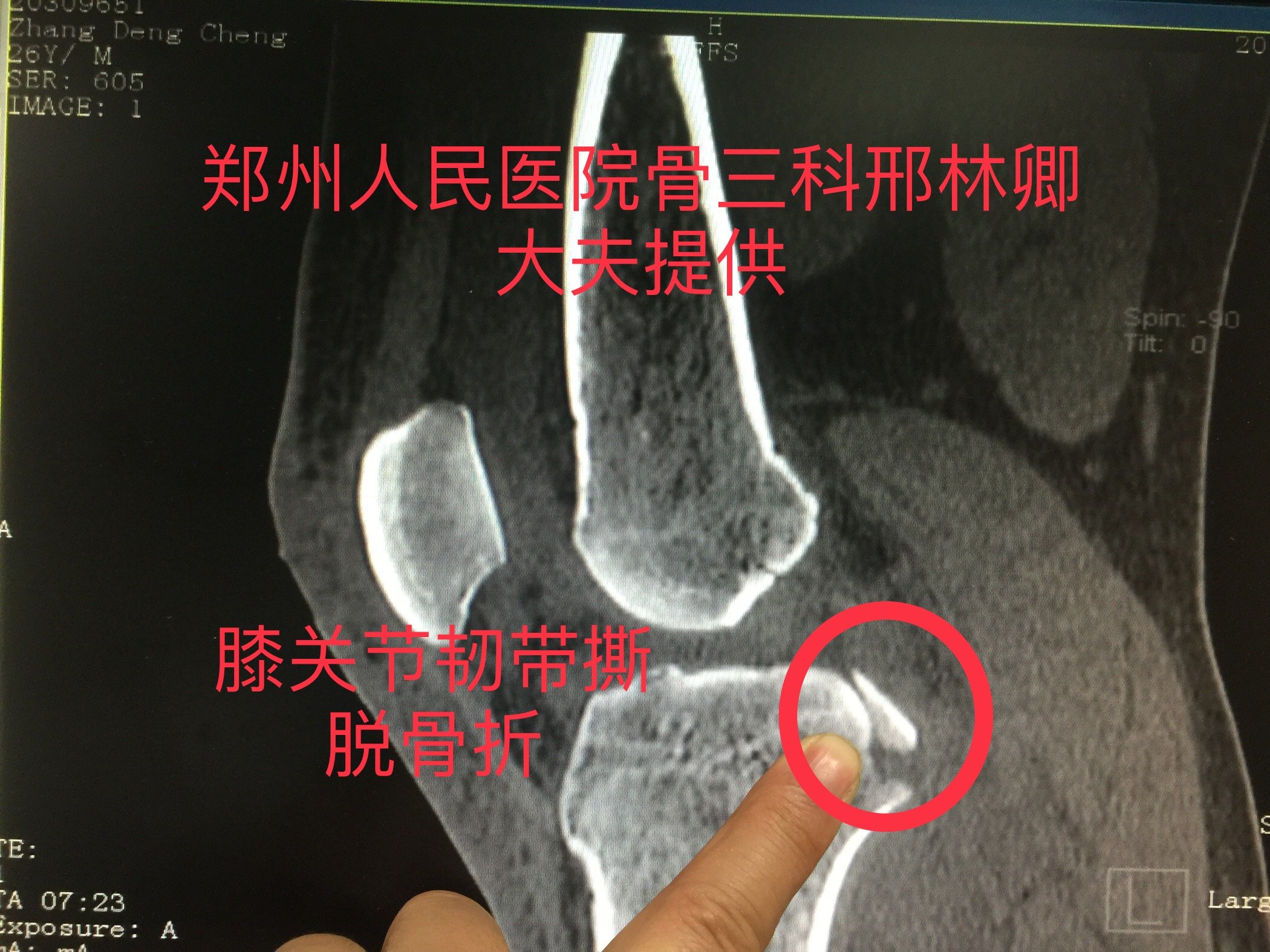 膝关节后交叉止点撕脱骨折关节镜手术治疗 避免开刀 膝关节后交叉止点撕脱骨折关节镜手术治疗 避免开刀