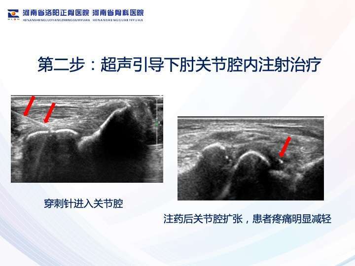 超声发现尺神经卡压患者手指麻木,前臂肌肉萎缩