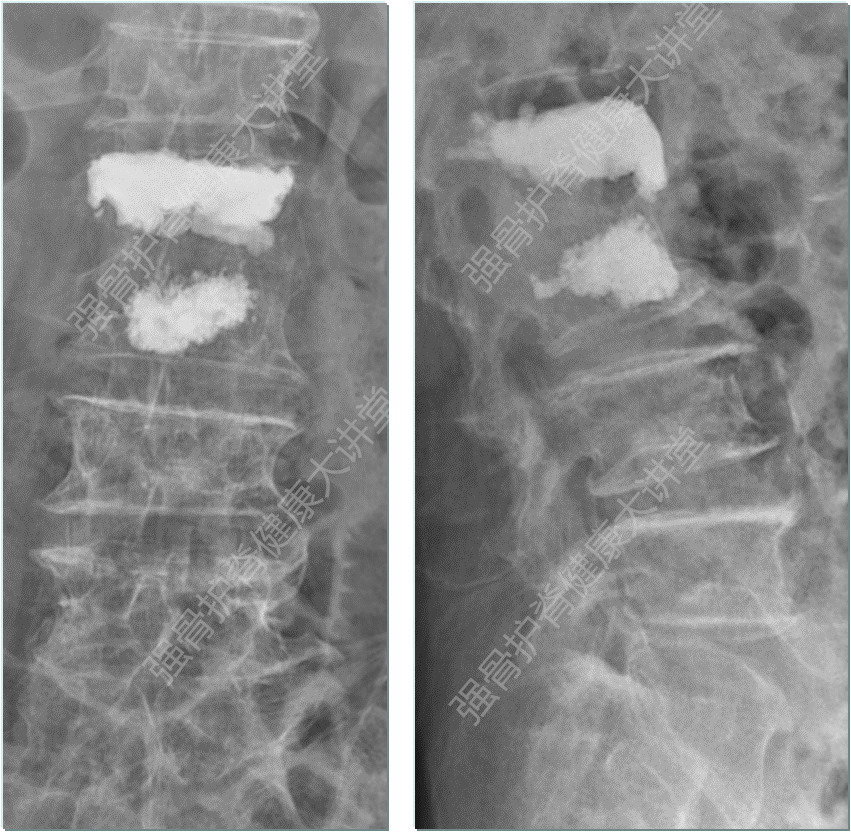 阻滞椎体双骨折,靶向锚定获稳效 - 好大夫在线