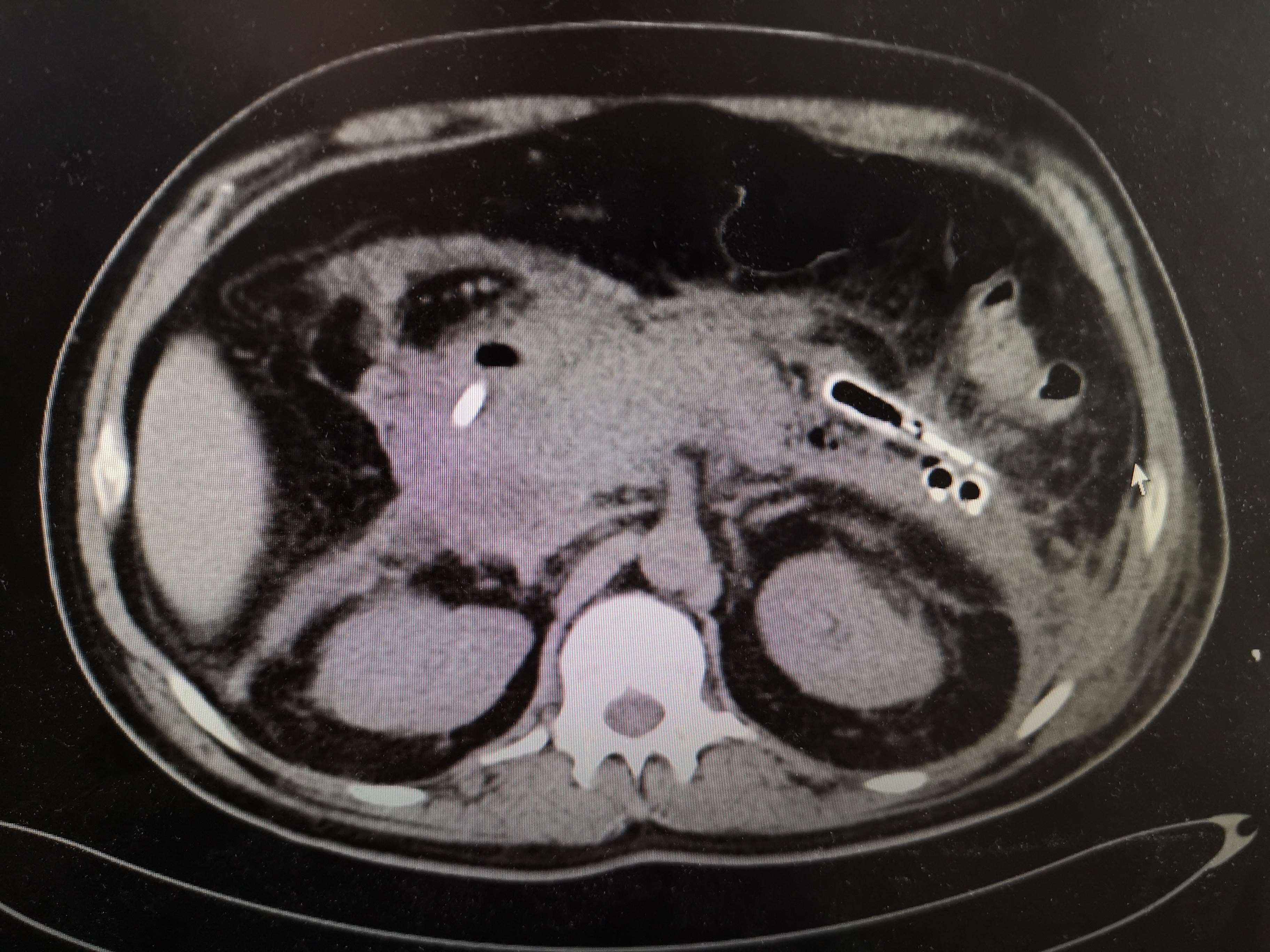 每周诊疗笔记之急性坏死性胰腺炎 - 好大夫在线