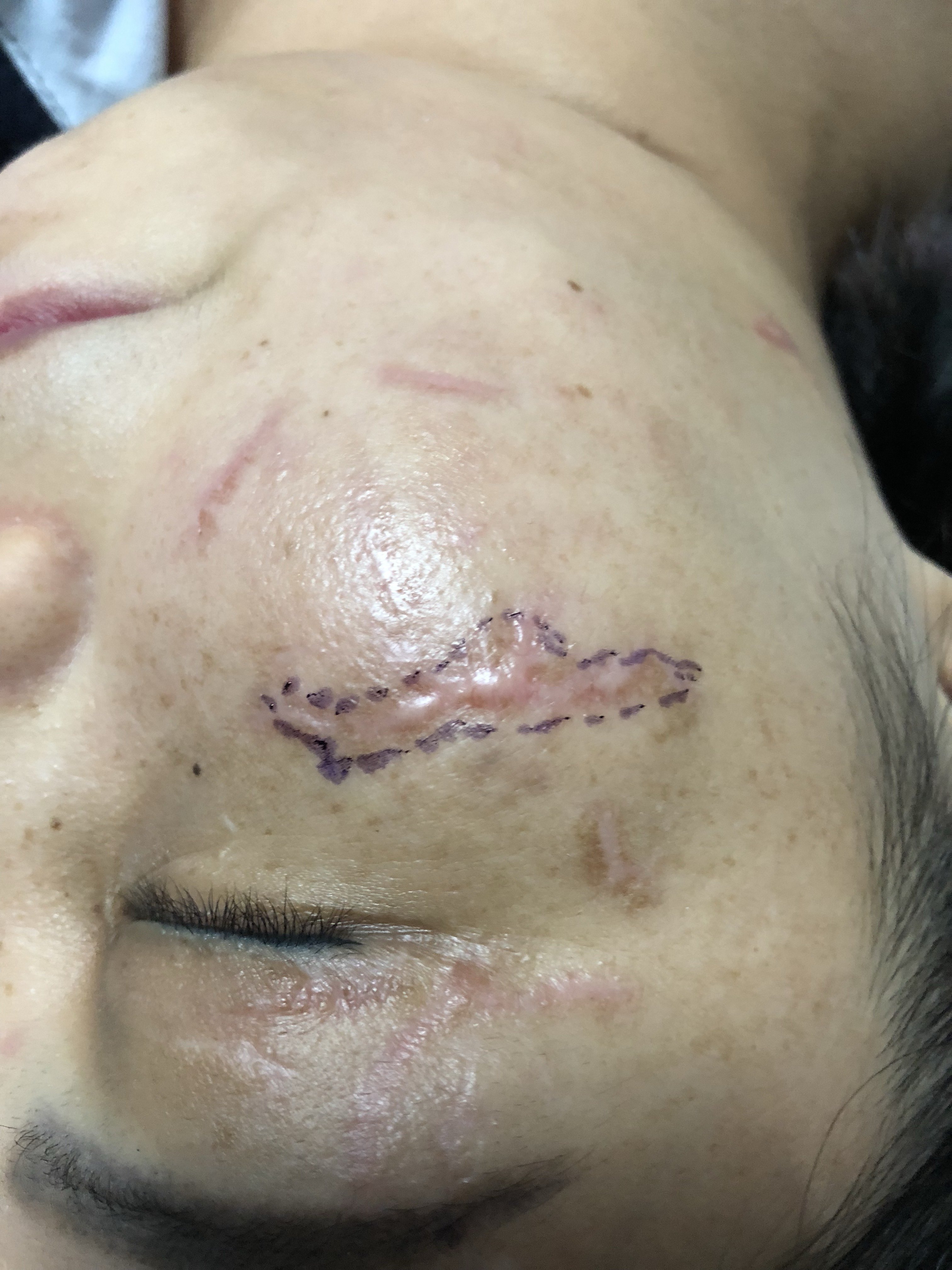 环钻其实是皮肤科的基本操作,常用于皮肤活检取材,只是有些整形医生太