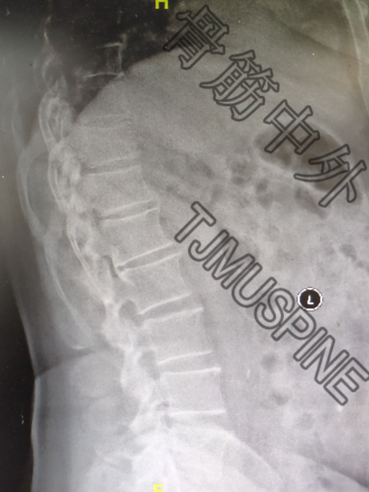 胸腰椎后路减压——一例严重的胸腰椎黄韧带骨化 - 好大夫在线