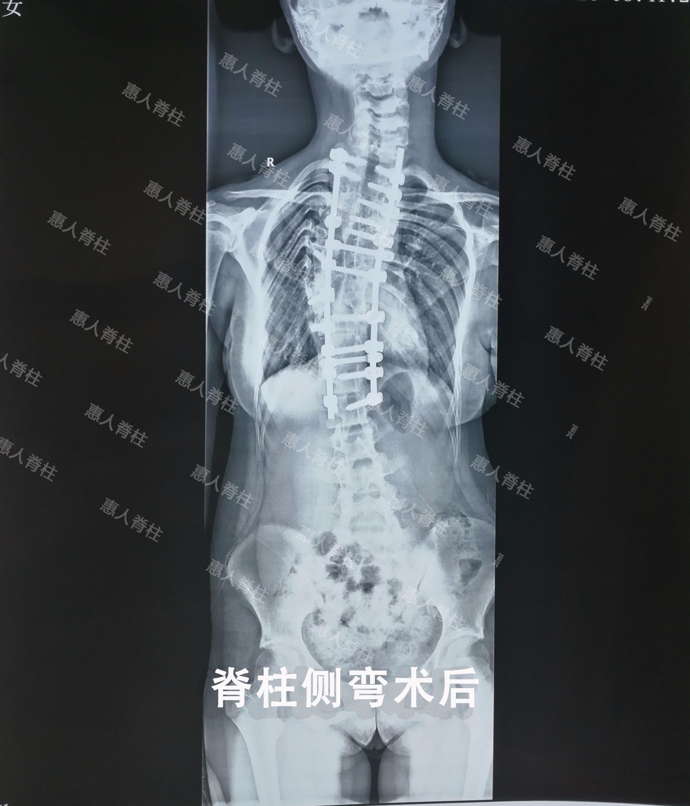 脊椎骨左侧凸起图片图片