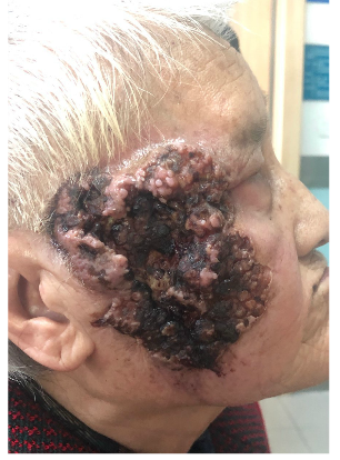 思维导图:中国特发性面神经麻痹诊治指南2016_面瘫_治疗方法_治疗方式