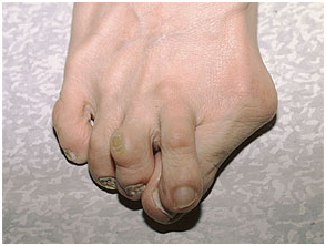 踇趾外翻时会向外侧侵占其他足趾的位置,导致临近足趾的屈曲畸形向上