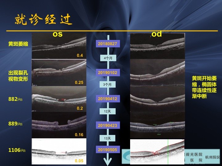 什么叫黄斑裂孔 uoYBAF1bsU-AXq_YAAEZYe-dUUA647.jpg?_ms_=8187
