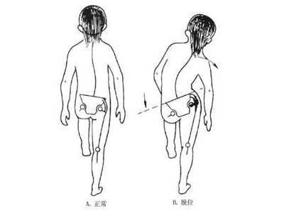 先天性髋脱位的治疗方式