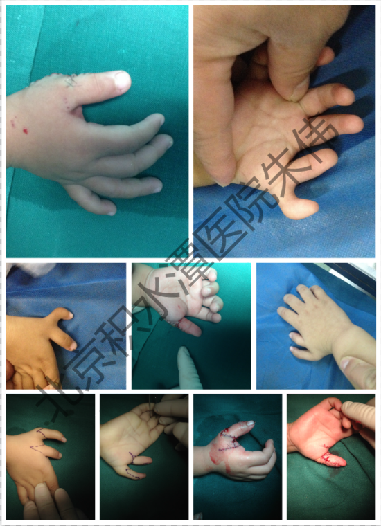 六指手术效果图图片