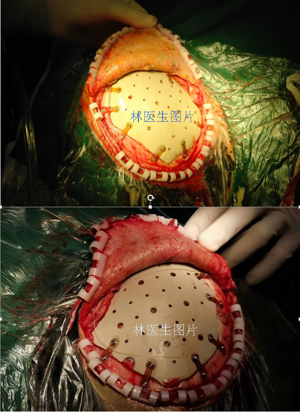 兒童做顱骨修補手術用鈦板還是peek材料