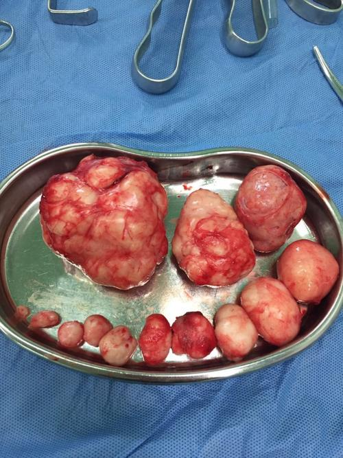 子宫肌瘤的手术指征及手术方式_子宫肌瘤_子宫肌瘤治疗方式 - 好大夫