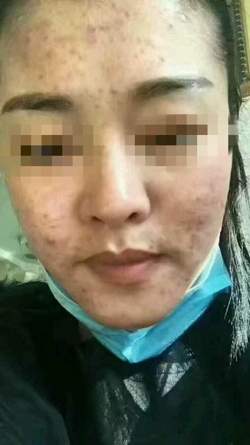 长期戴口罩如何做好皮肤护理 痤疮 痤疮 长期戴口罩如何做好皮肤护理 痤疮 痤疮