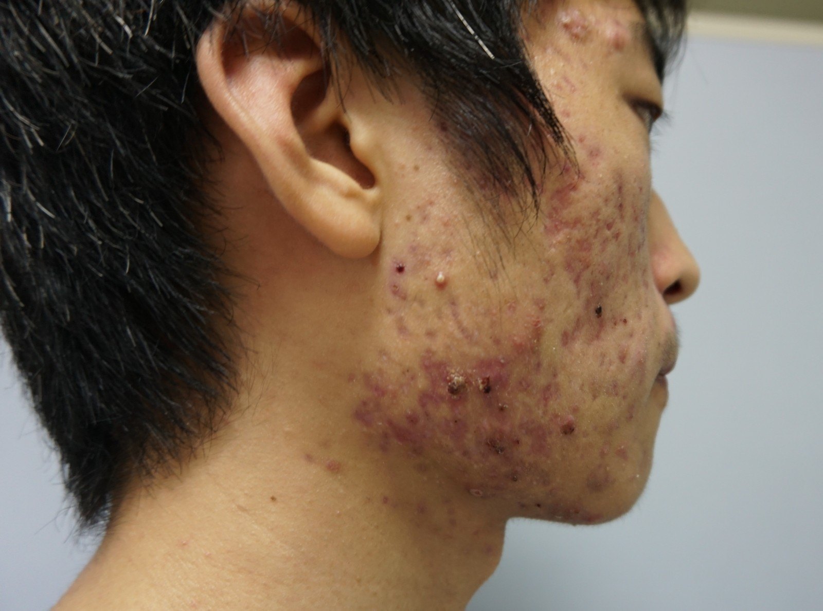 哪里治疗青春痘好呀_青春痘治疗绝技_青春痘治疗方案