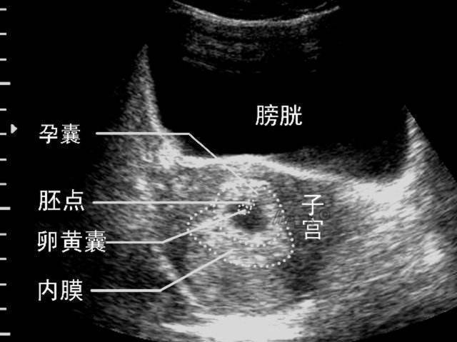 试管后一超 二超 三超要看什么 试管婴儿 试管婴儿