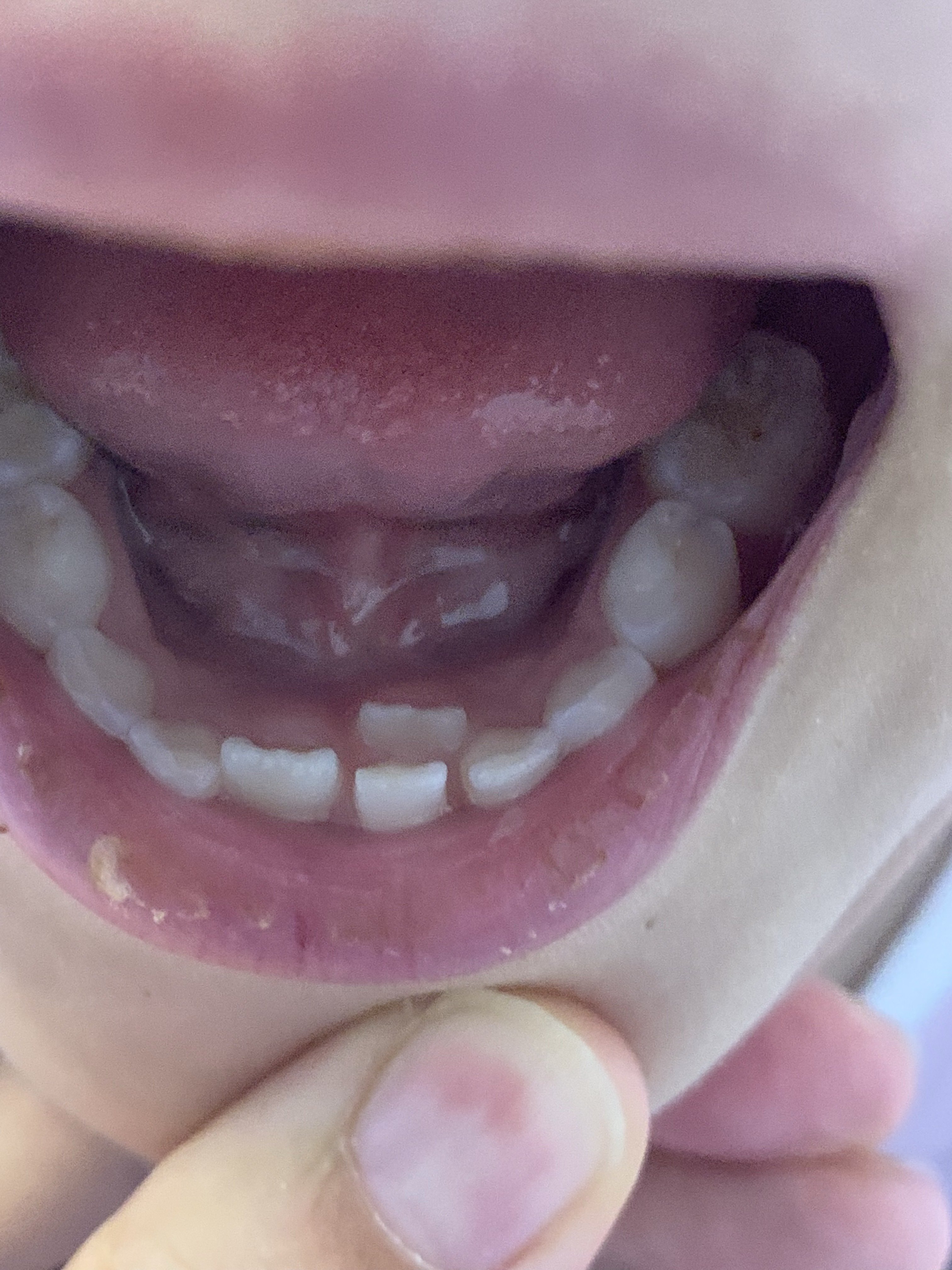 儿童乳牙牙根戳破牙龈图片