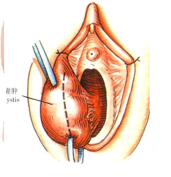 前庭大腺囊肿