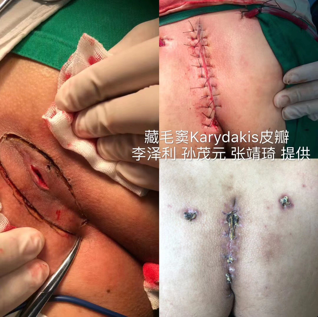 骶尾部藏毛窦karydakis皮瓣手术
