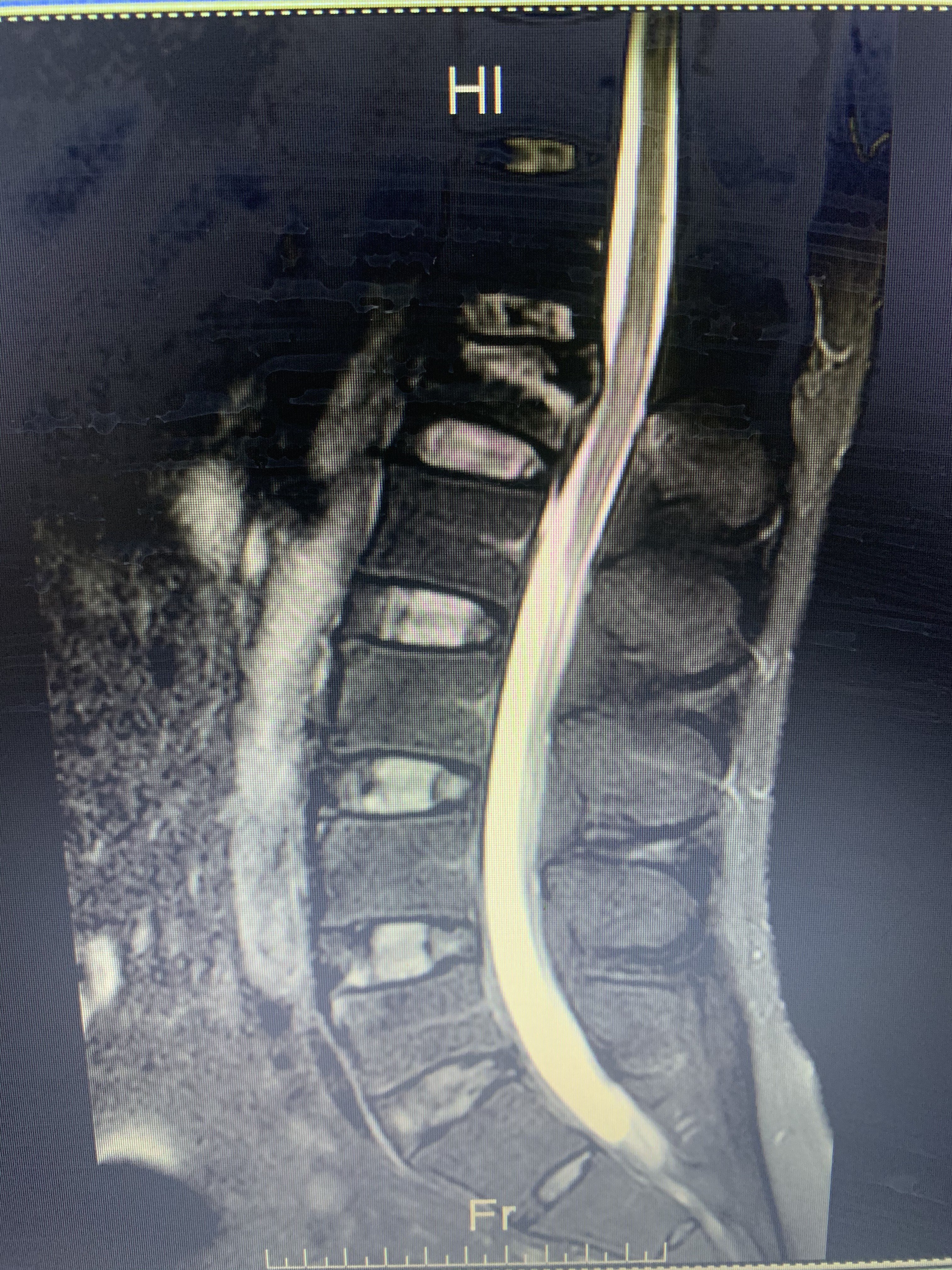 腰椎爆裂骨折并脊髓损伤 
