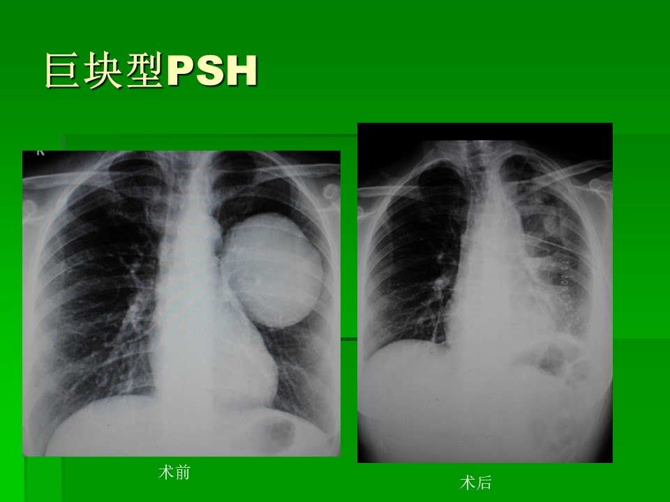 肺部良性肿瘤 肺硬化性肺泡细胞瘤 肺硬化性血管瘤是什么肿瘤 需要手术切除吗 肺肿瘤