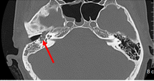 中耳乳突炎ct图片图片