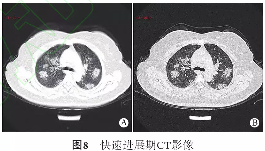 新冠肺炎典型ct表现 - 好大夫在线