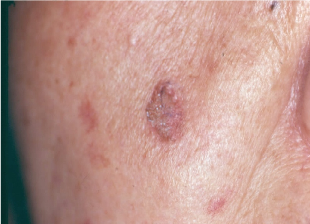 鳞状细胞癌早期症状图片