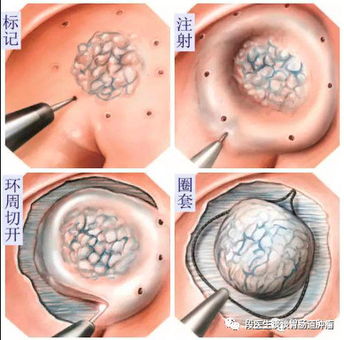 肠息肉手术夹子脱落图片