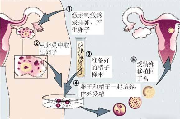 试管婴儿一代更比一代强吗 第四代最好吗 试管婴儿 试管婴儿